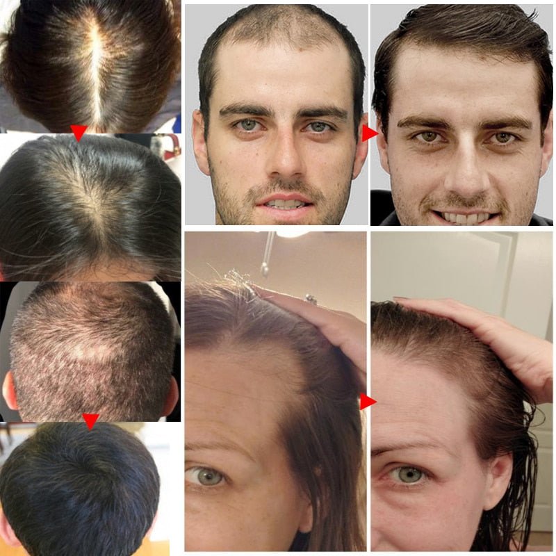 Óleo de gengibre - Cresce cabelo resultado em 7 dias - Premium  from ZLA - Just $5! Shop now at ZLA